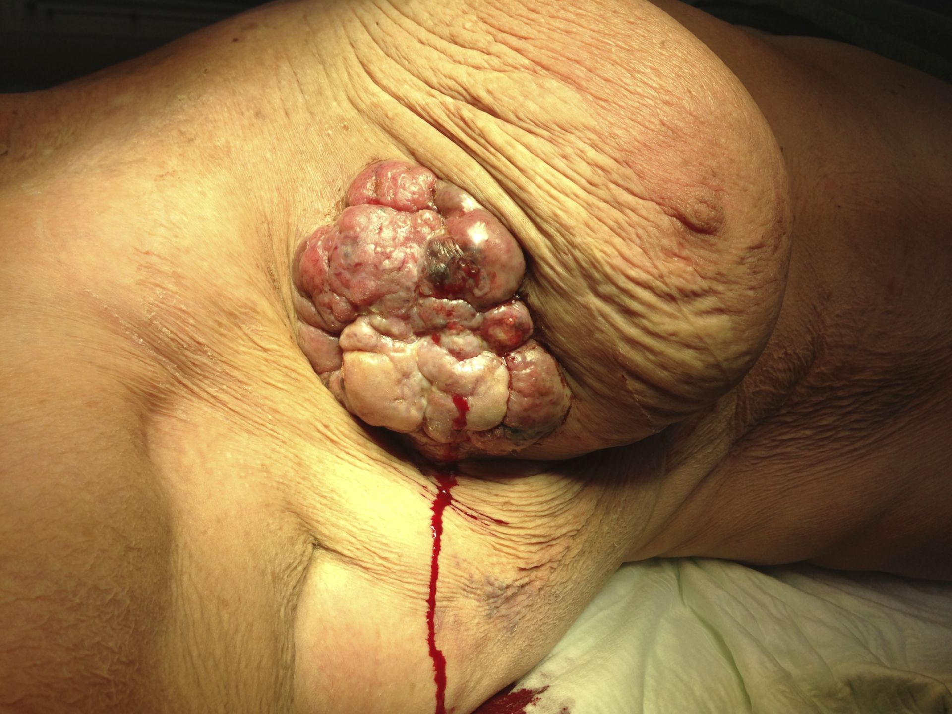 Cancro della mammella ulcerato (2)