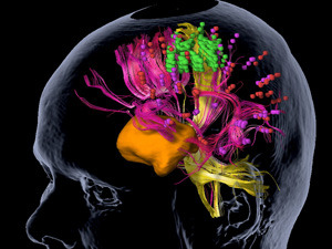 nTMS-Kartierung eines Tumors (orange): In pink sind die Nervenbahnen und essentiellen Positionspunkte für Sprachregionen dargestellt, wichtige Punkte des Bewegungsareals sind in grün, Nervenbahnen in gelb abgebildet. © Sandro Krieg / TUM