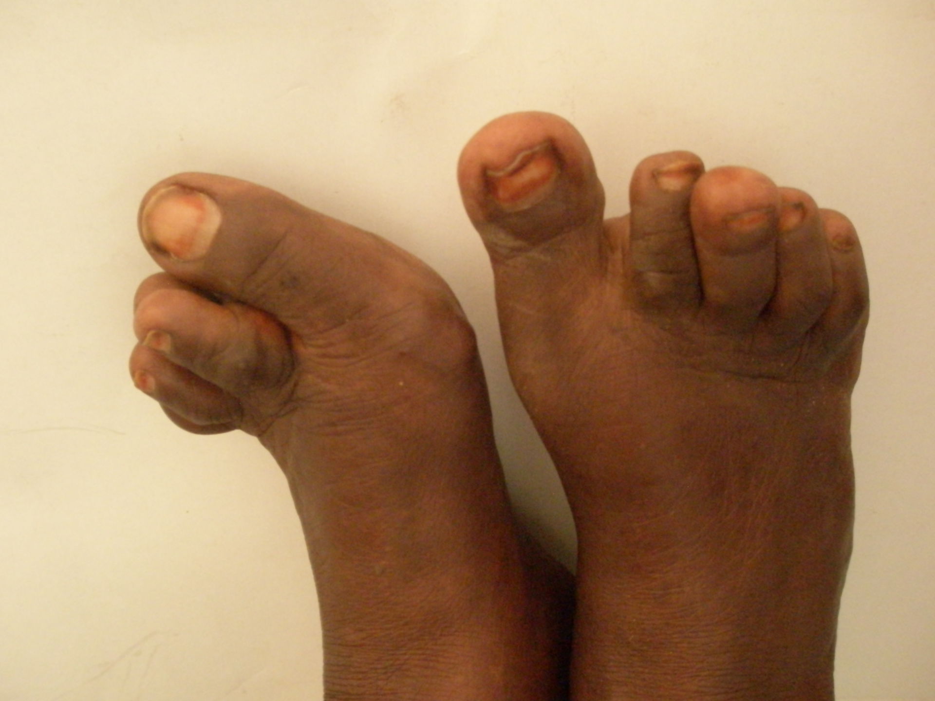 Rheumatoide Arthritis - Fuß