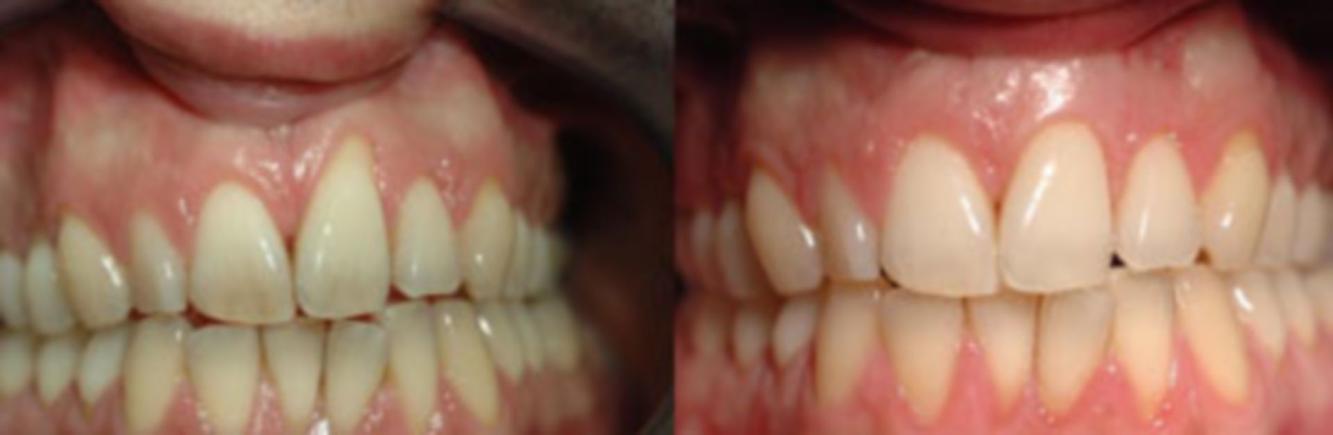 Intraoraler Befund bei Erhebung des Zahnstatus