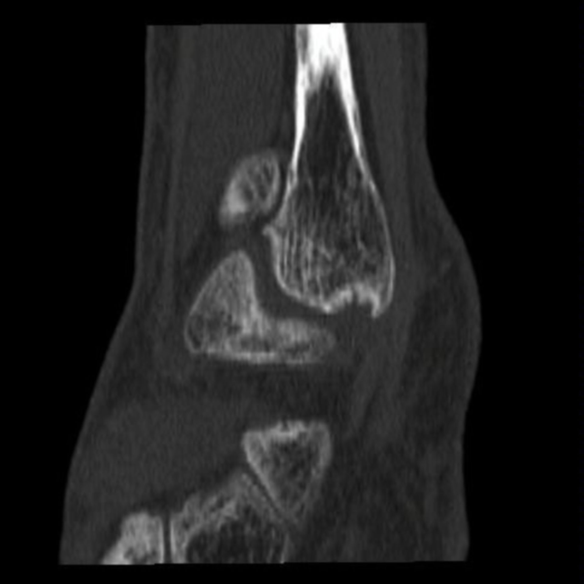 44+ Tumor im knie bilder , MRT Knie DocCheck