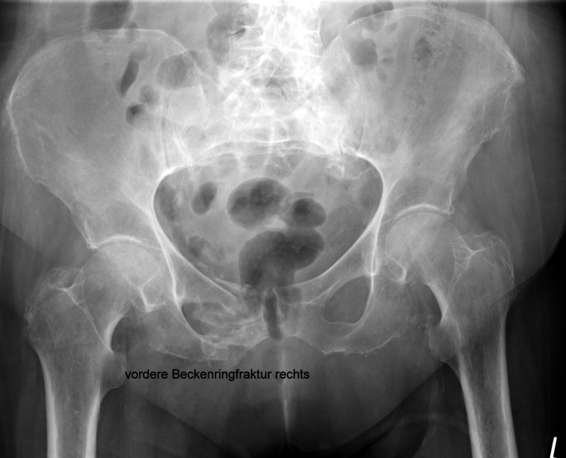 Pelvic ring fracture in patient with osteoporosis right