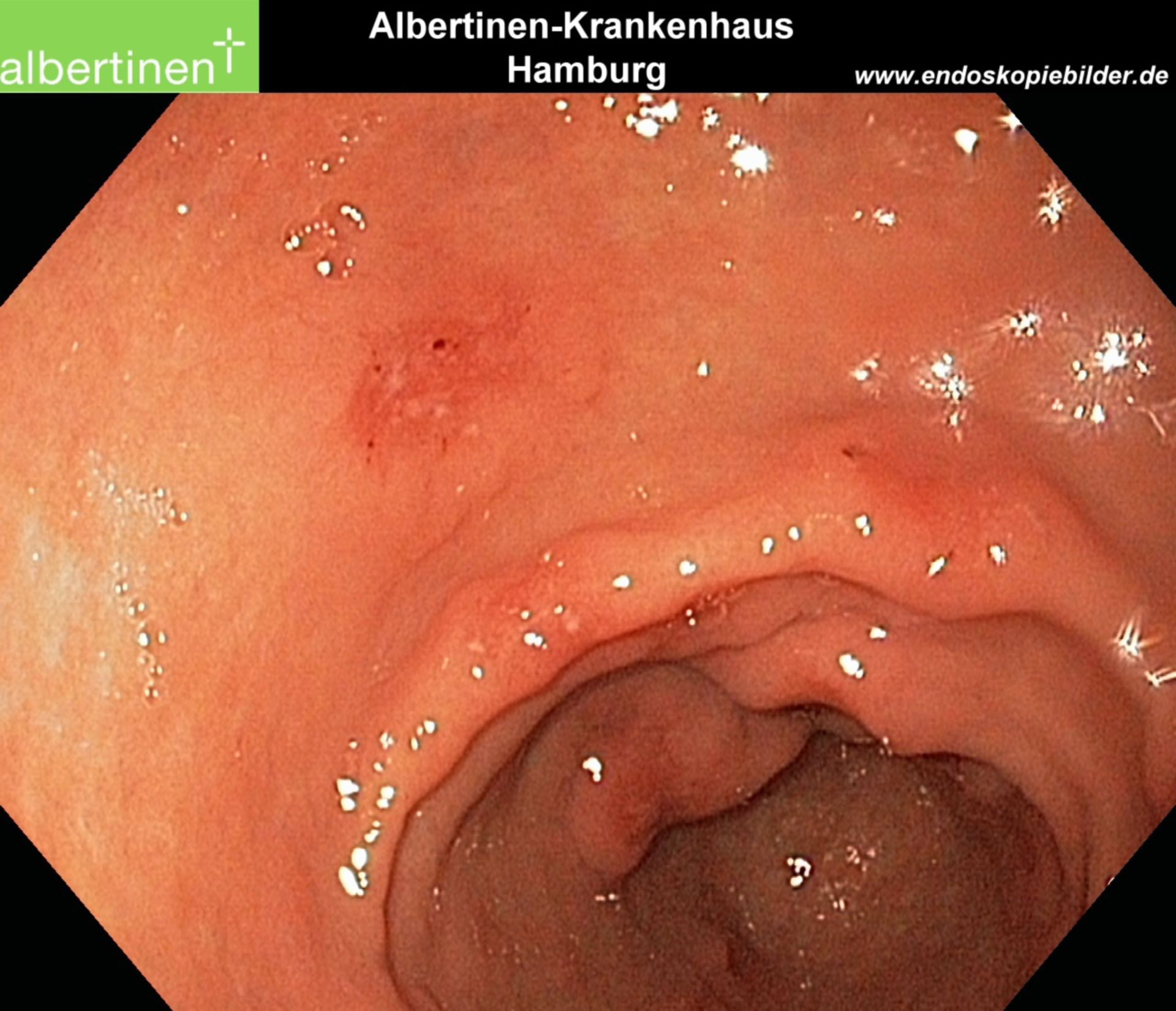 Endoscopia: gastropatia da Helicobacter