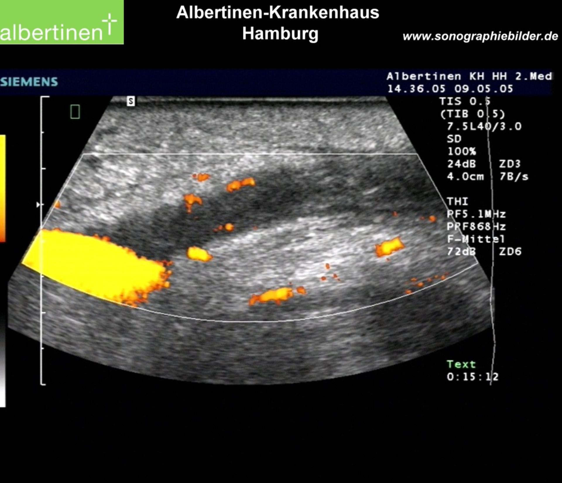 Thrombosis of the Venae basilica, Powermode