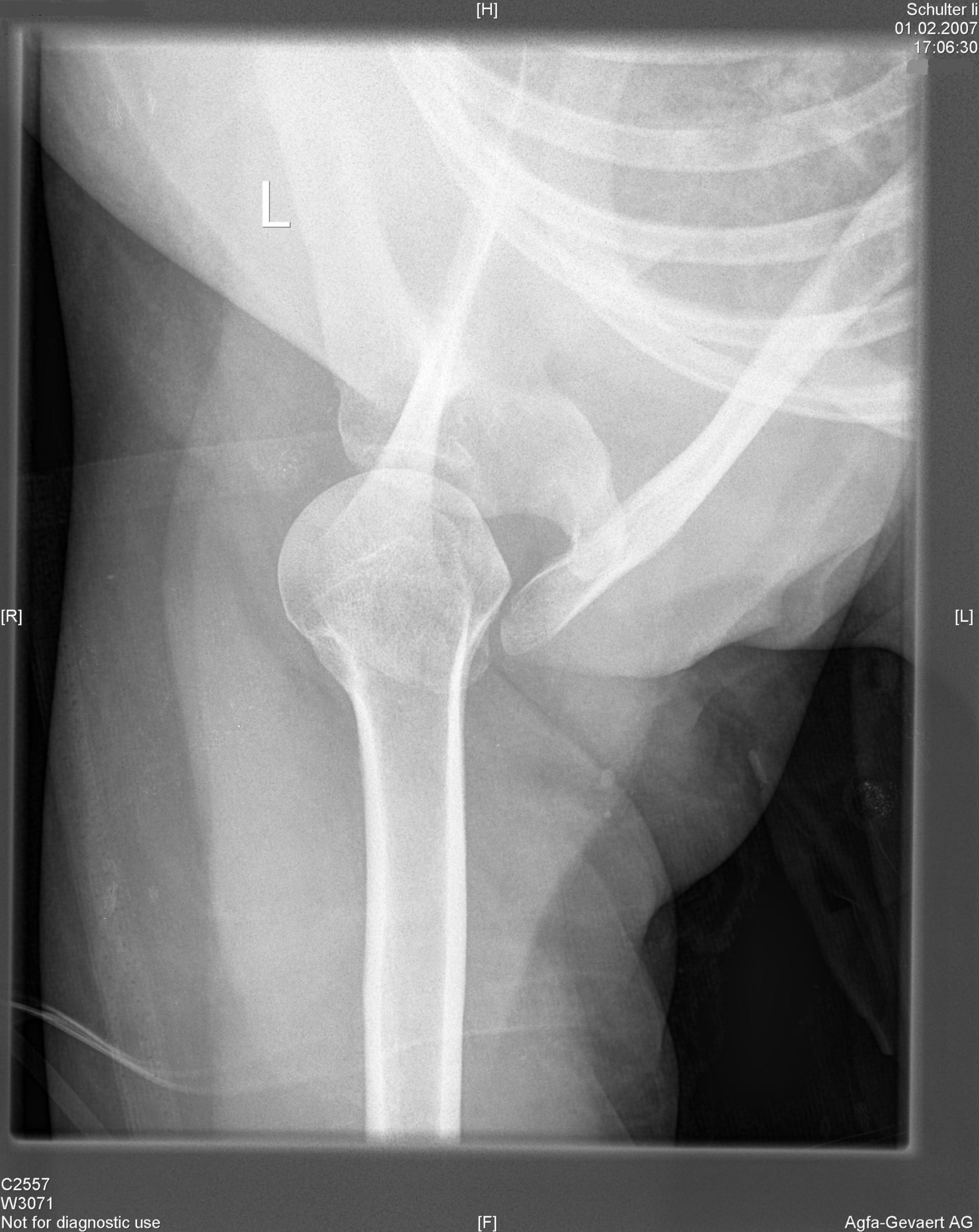 X-ray of the left shoulder, axial