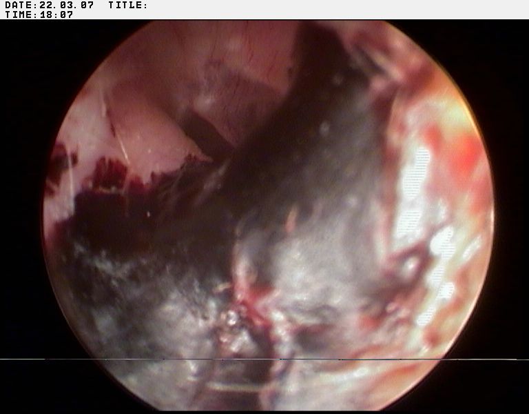 Small amounts of blood in ear canal?