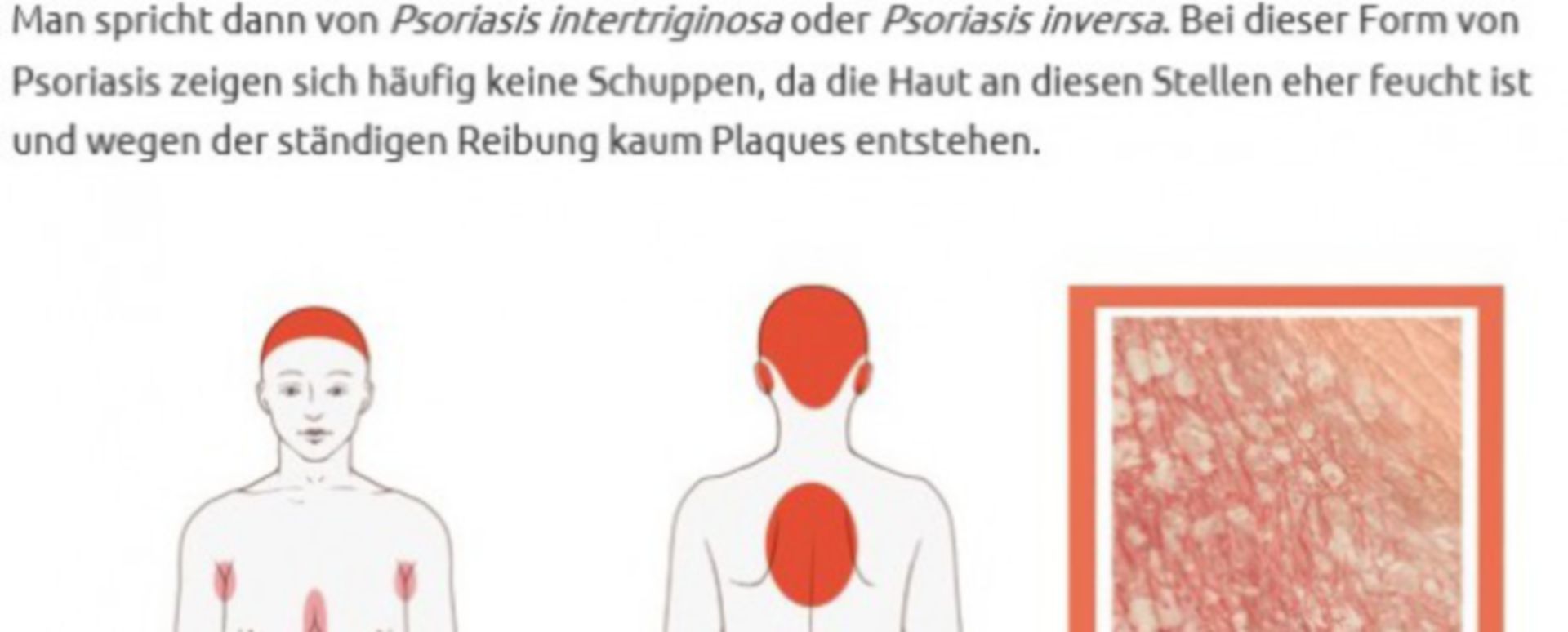 Schuppenflechte (Psoriasis) - DocCheck