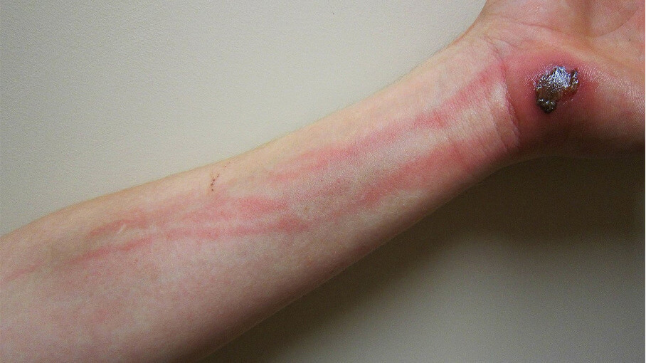 arm_blutstrominfektion_original.jpg