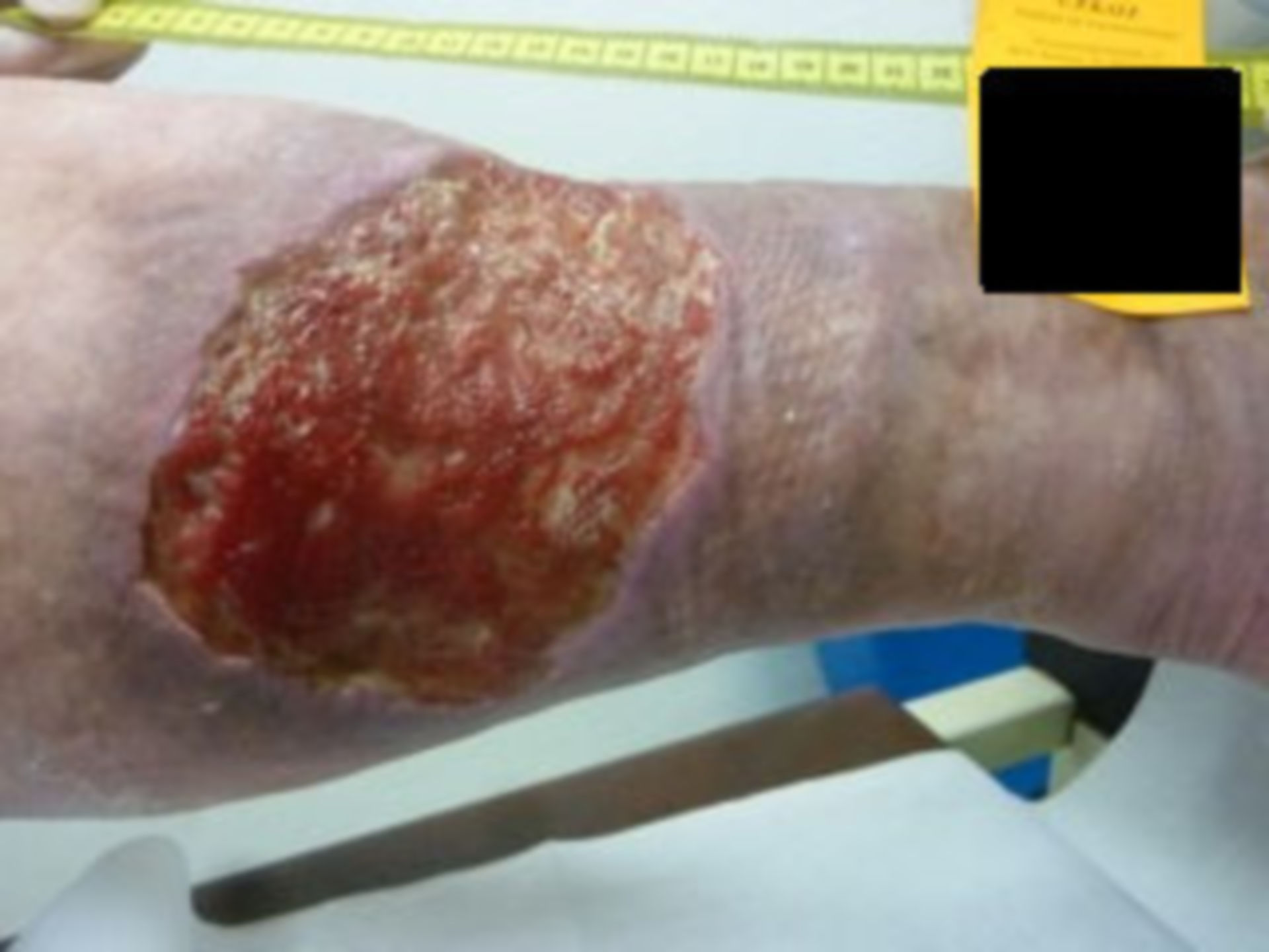 7 years open (23) - healing process