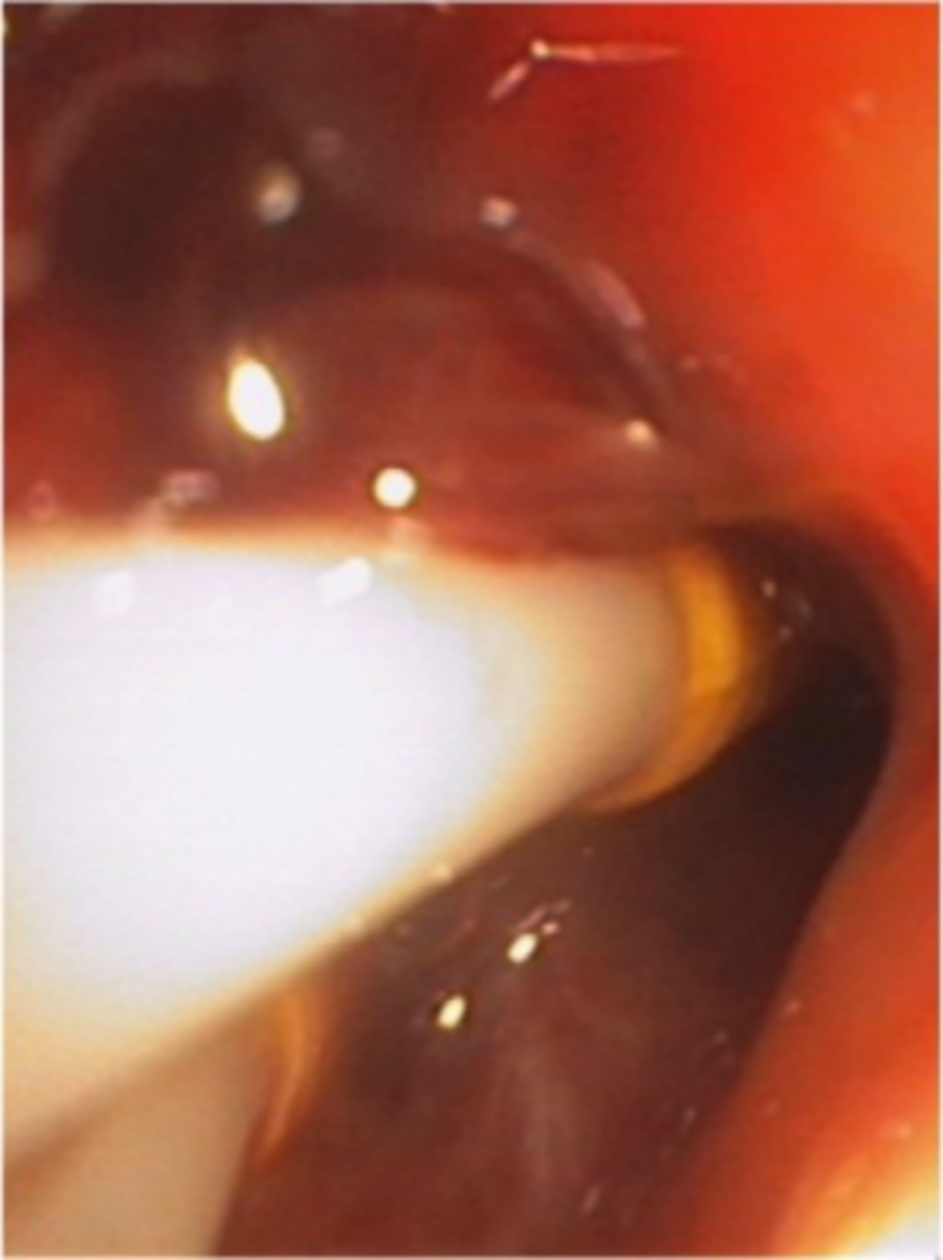 Endobronchiale Blutung