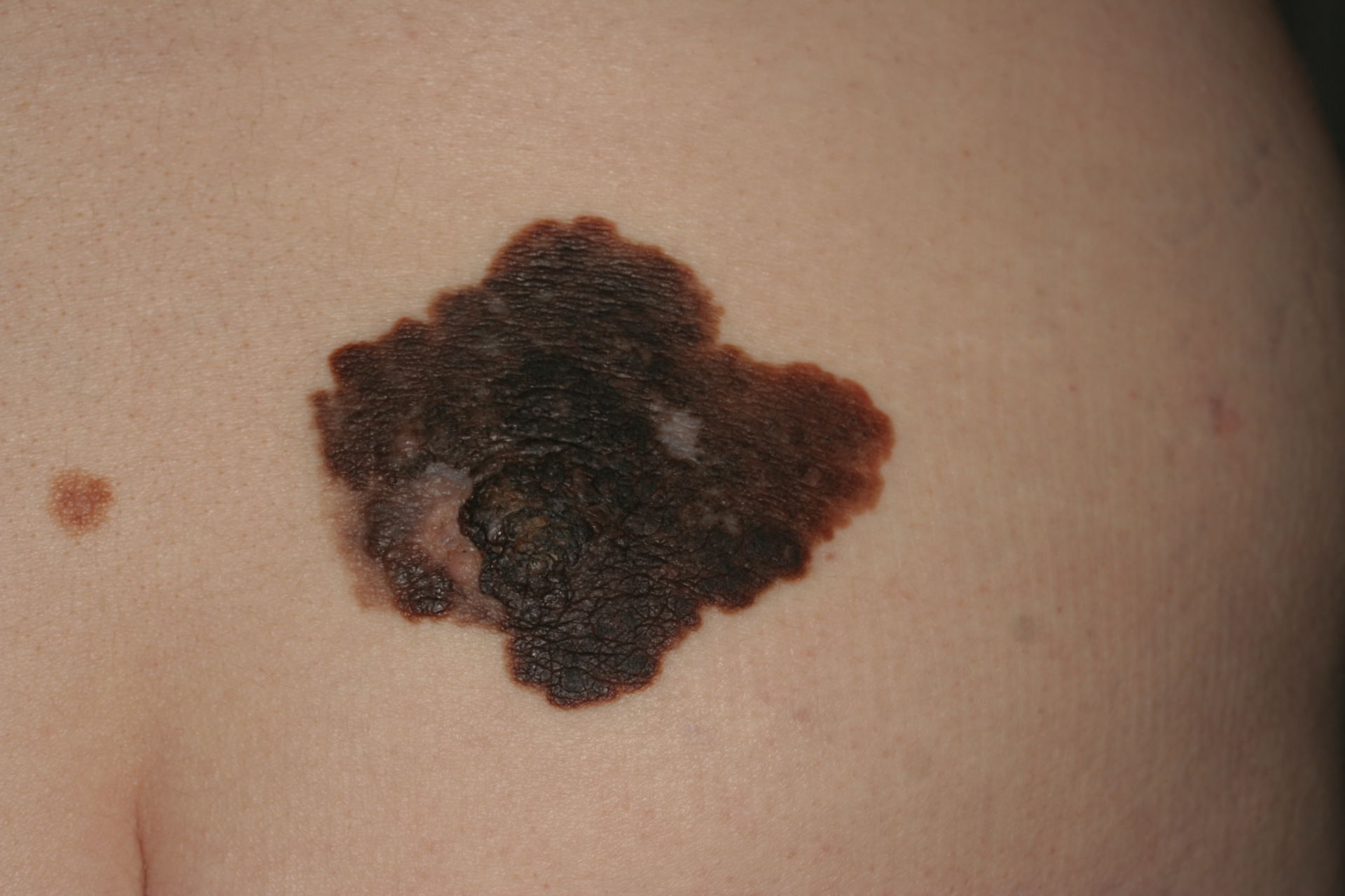 Superficially spreading malignant melanoma
