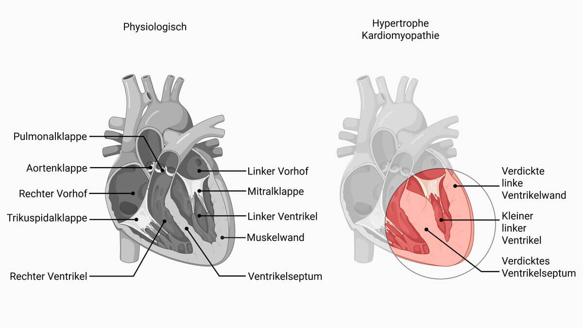 Hypertrophe Kardiomyopathie