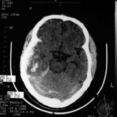 Offenes Schädel-Hirn-Trauma - DocCheck Flexikon