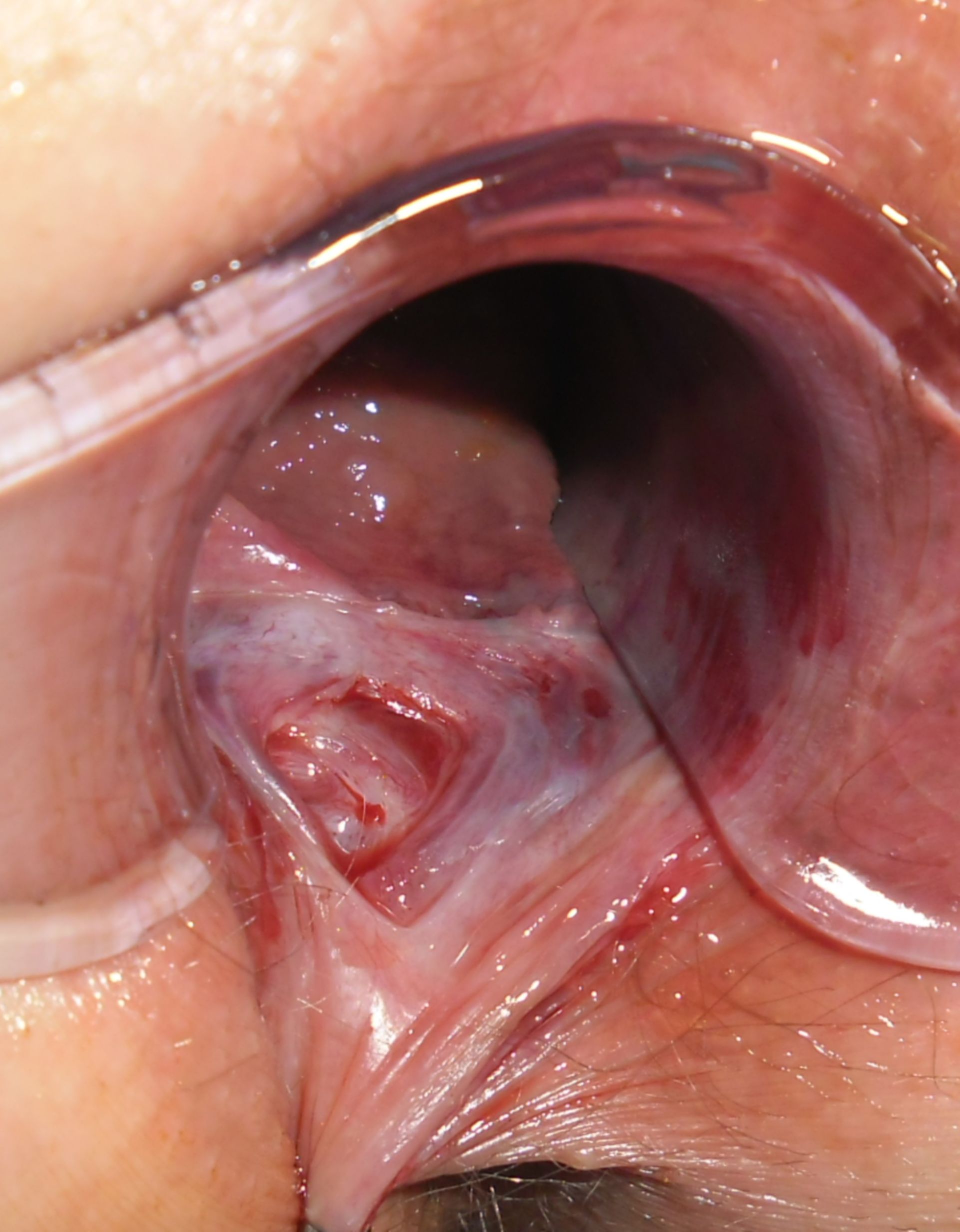 A Case Of Anal Fissure.