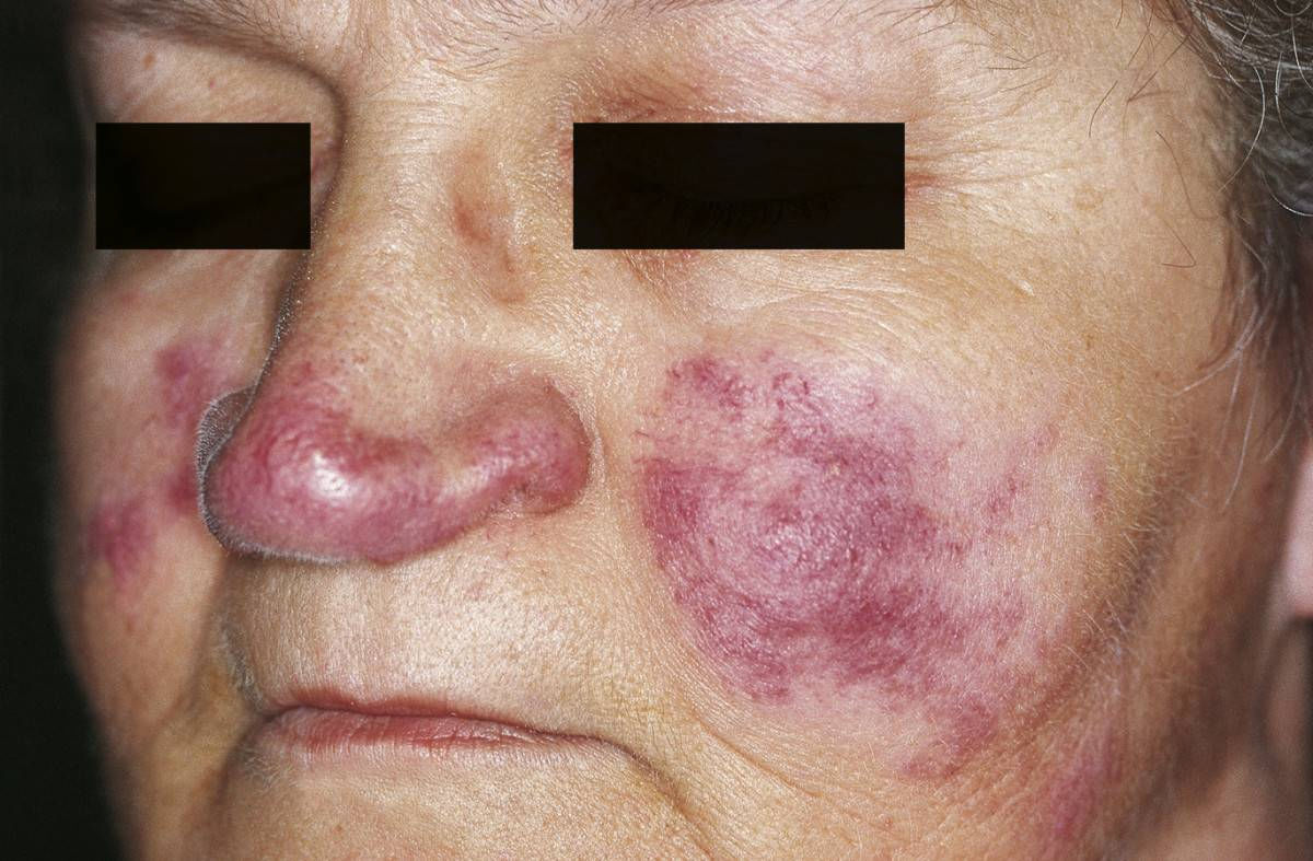 Hautläsionen bei Sarkoidose (Lupus pernio)