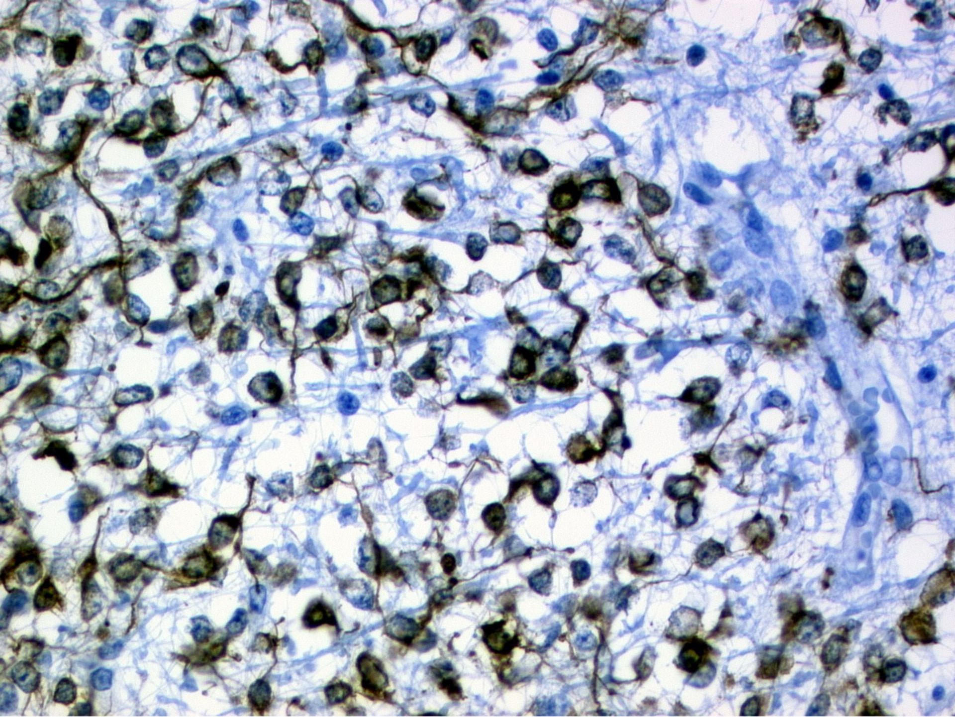 Oligodendroglia cells of a glioblastoma