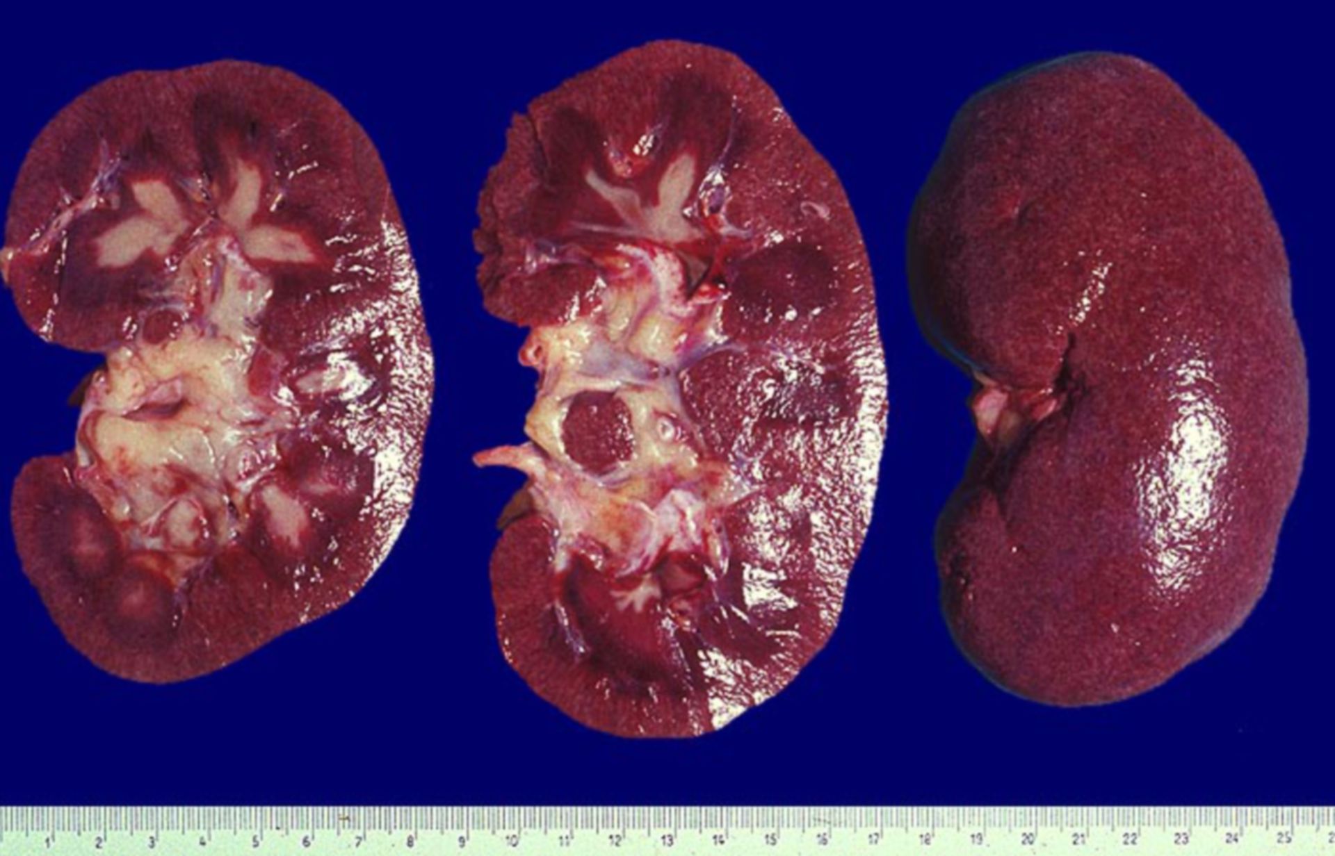 Lupus eritematoso: necrosi papillare