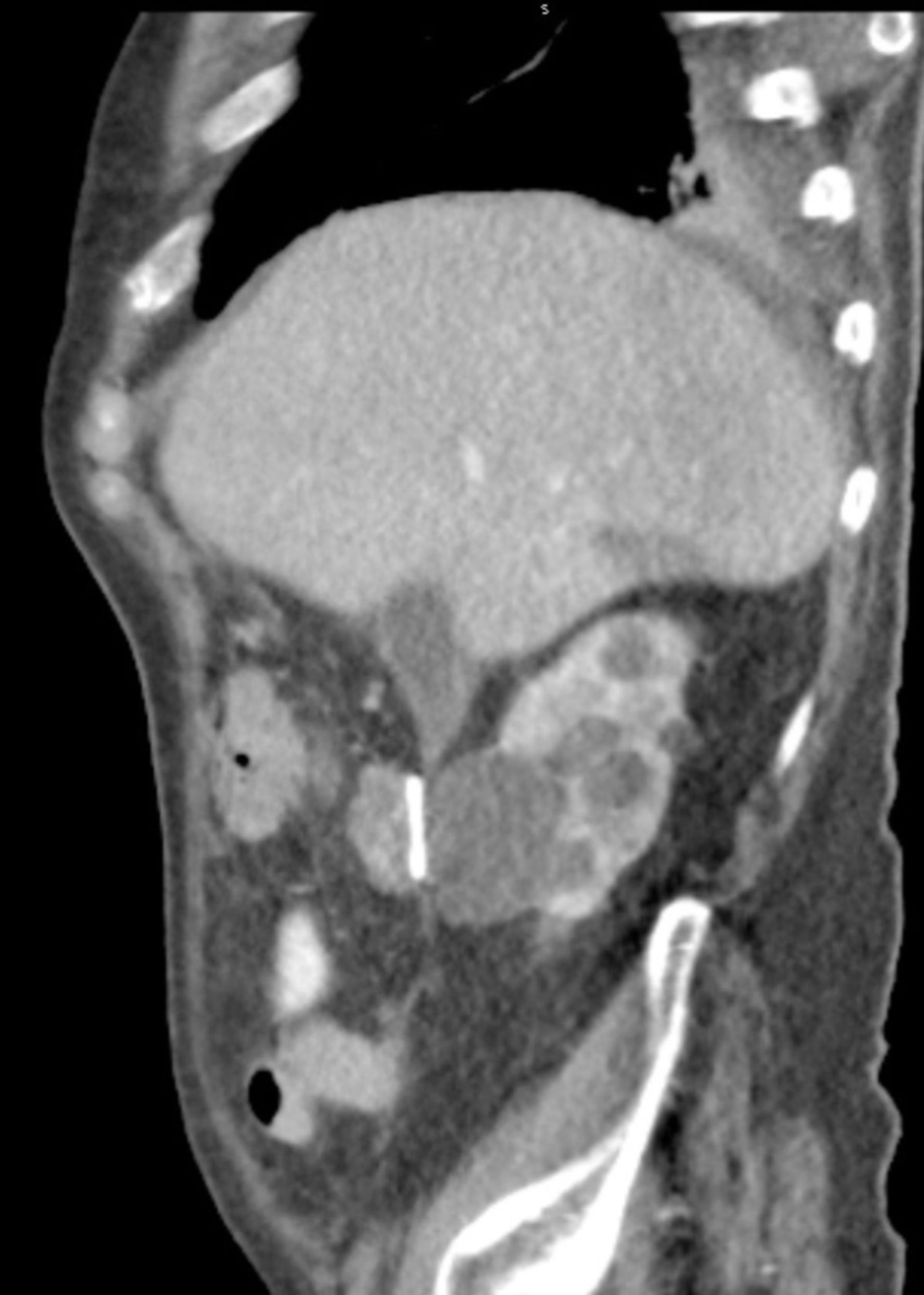 CT des Abdomens in sagittaler Ebene mit Cystenniere rechts.