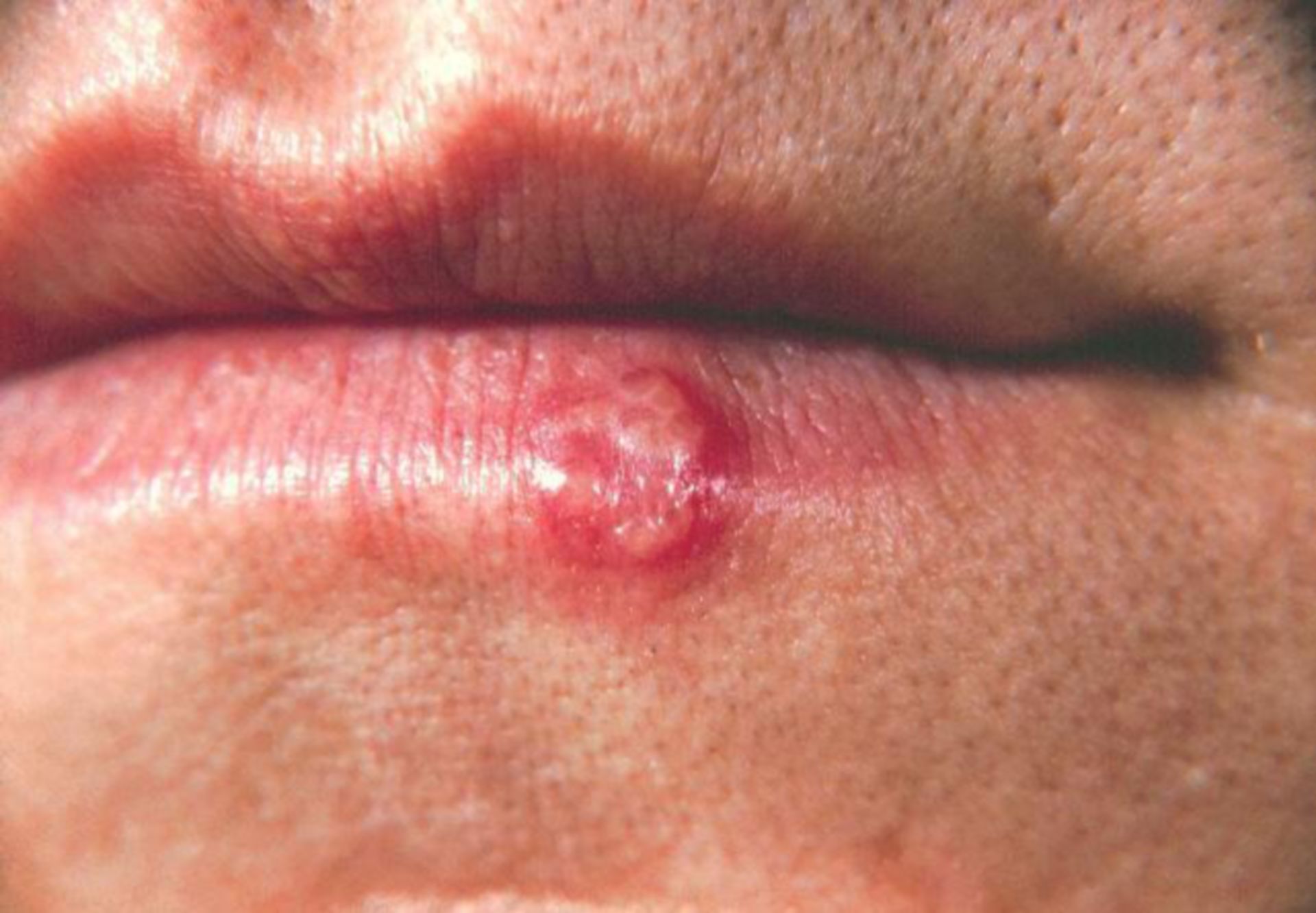 Herpes simplex lesion (3)