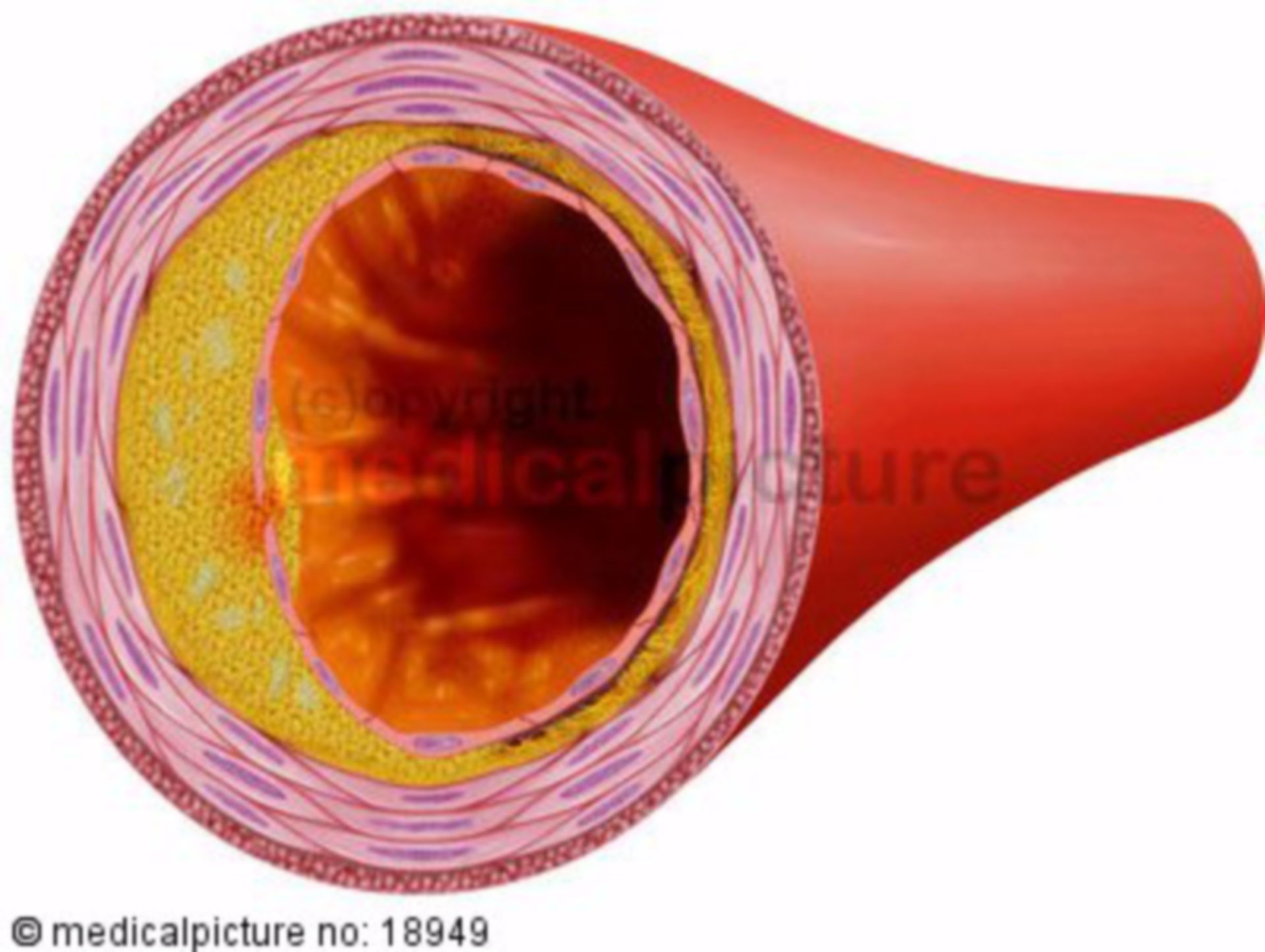 Arteriosklerotisches Blutgefäß, Arterienverkalkung