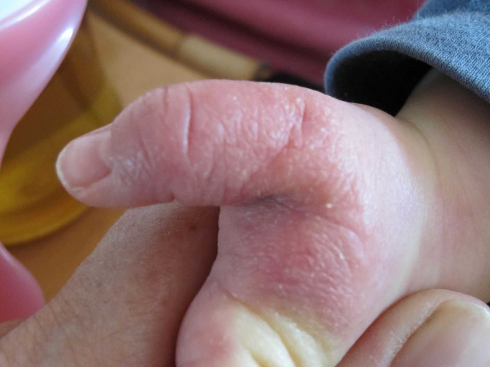 Eczema di una bambina di un anno e mezzo