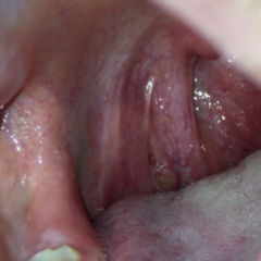 Ca tonsillen HPV