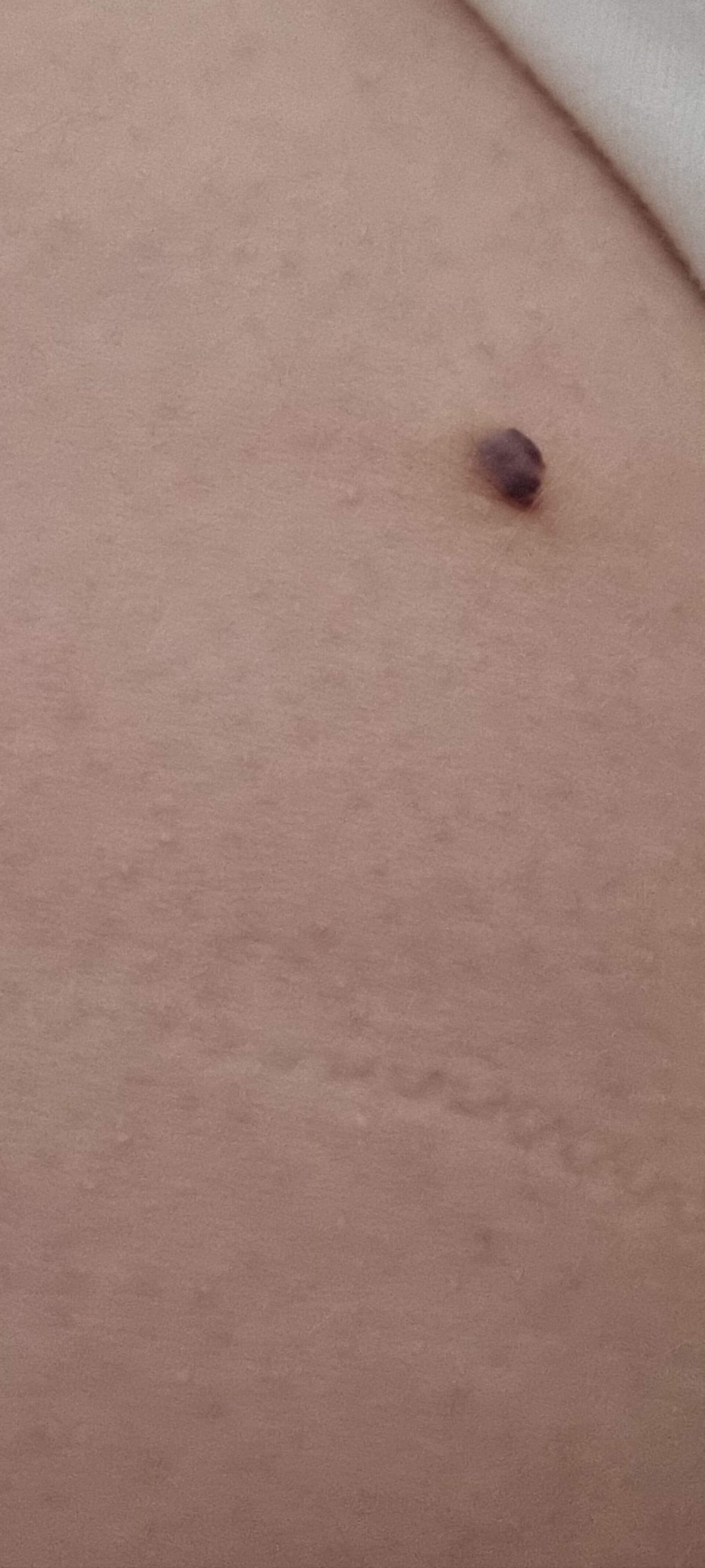 Angioma?