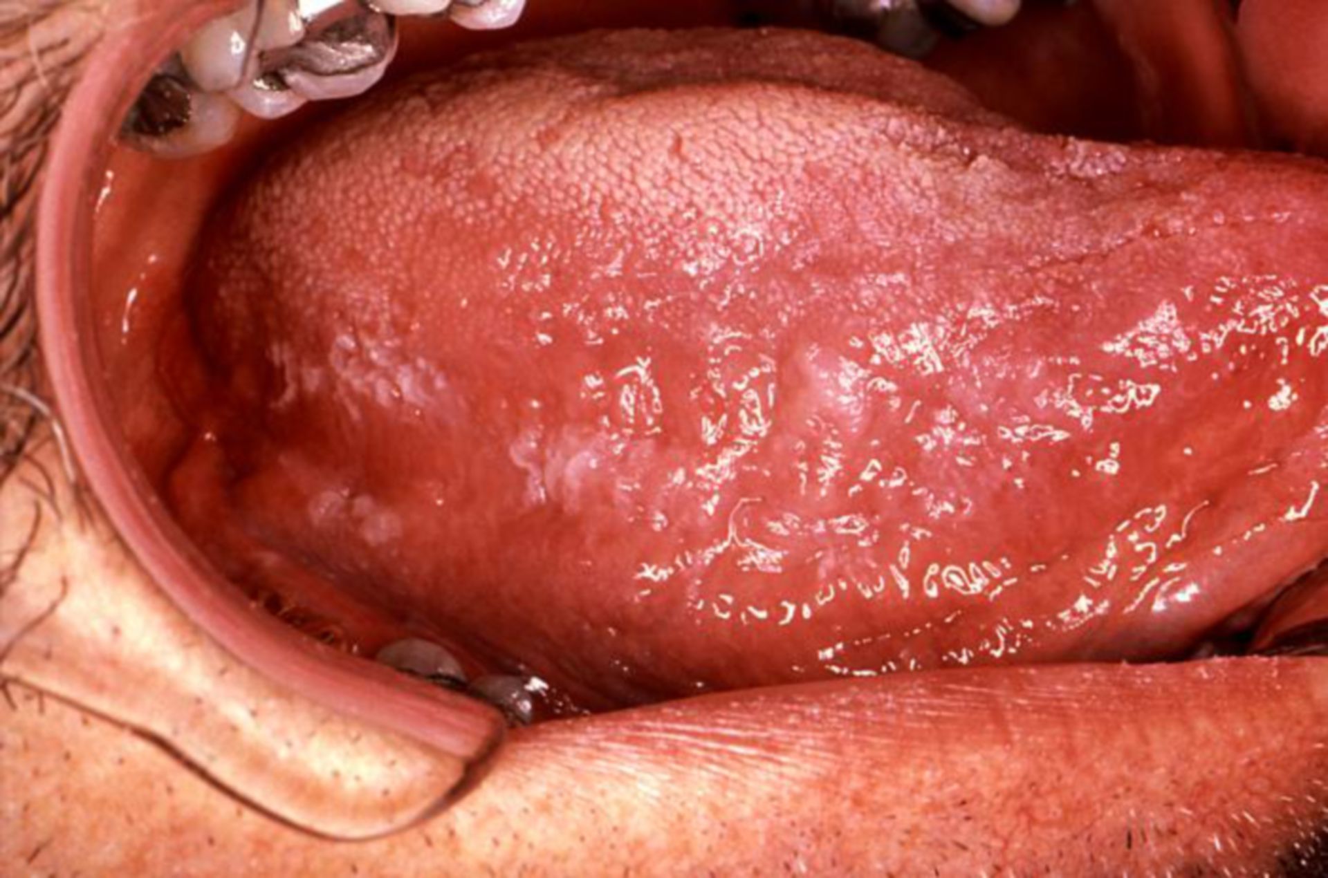 Orale Erkrankung bei AIDS: Leukoplakie (2)