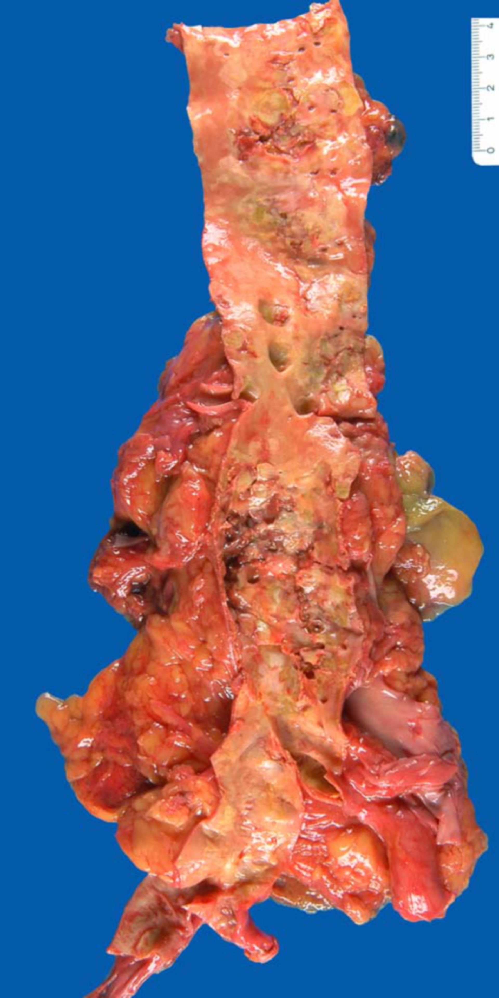 Atherosclerosis of the aorta