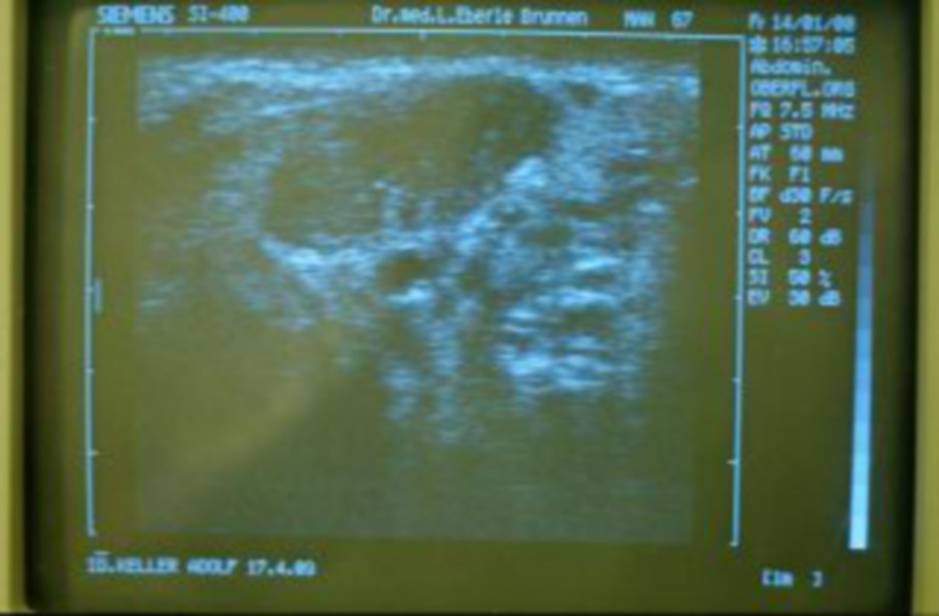 Ultrasound image neck cyst