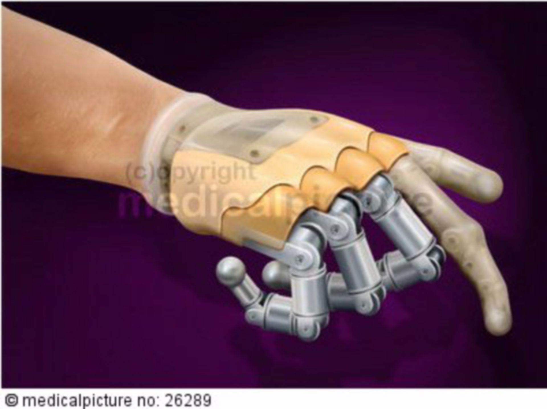  Modellierung einer Handprothese 
