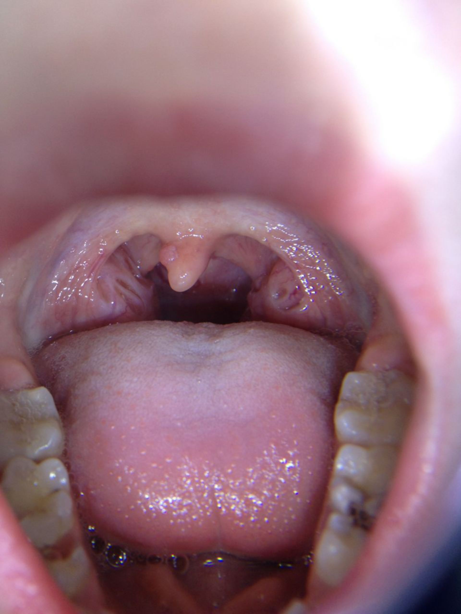 papilloma from uvula)
