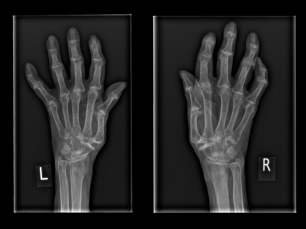 Rheumatoide Arthritis