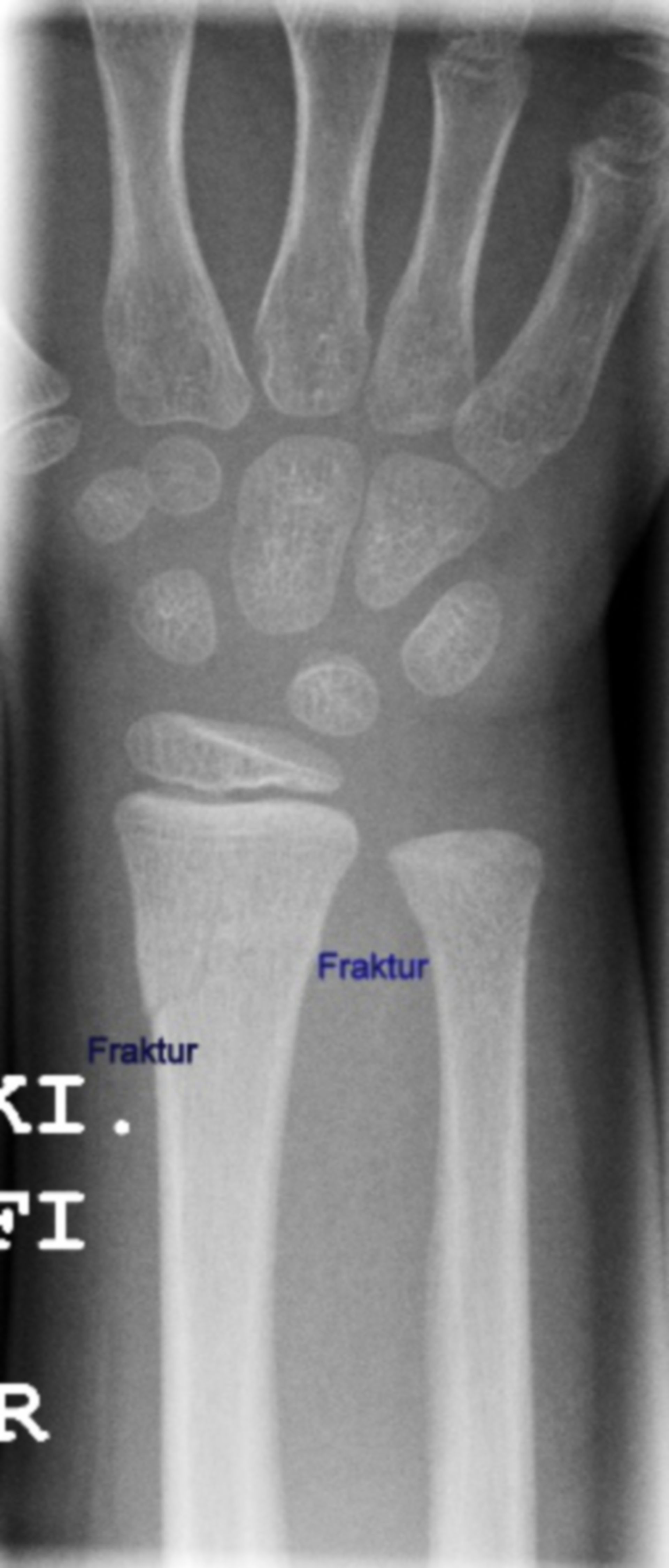 Greenstick fracture of the lower arm