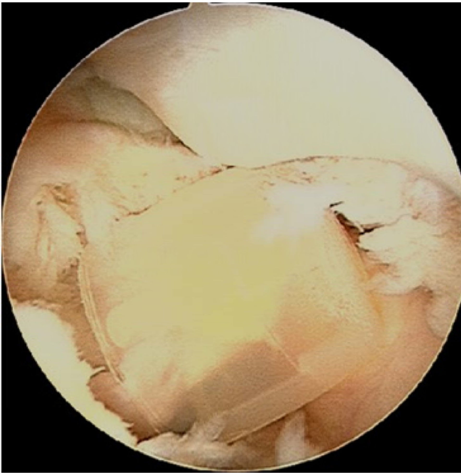 Soft drink bottle cap within the femoral intercondylar notch, anterior to the ACL.