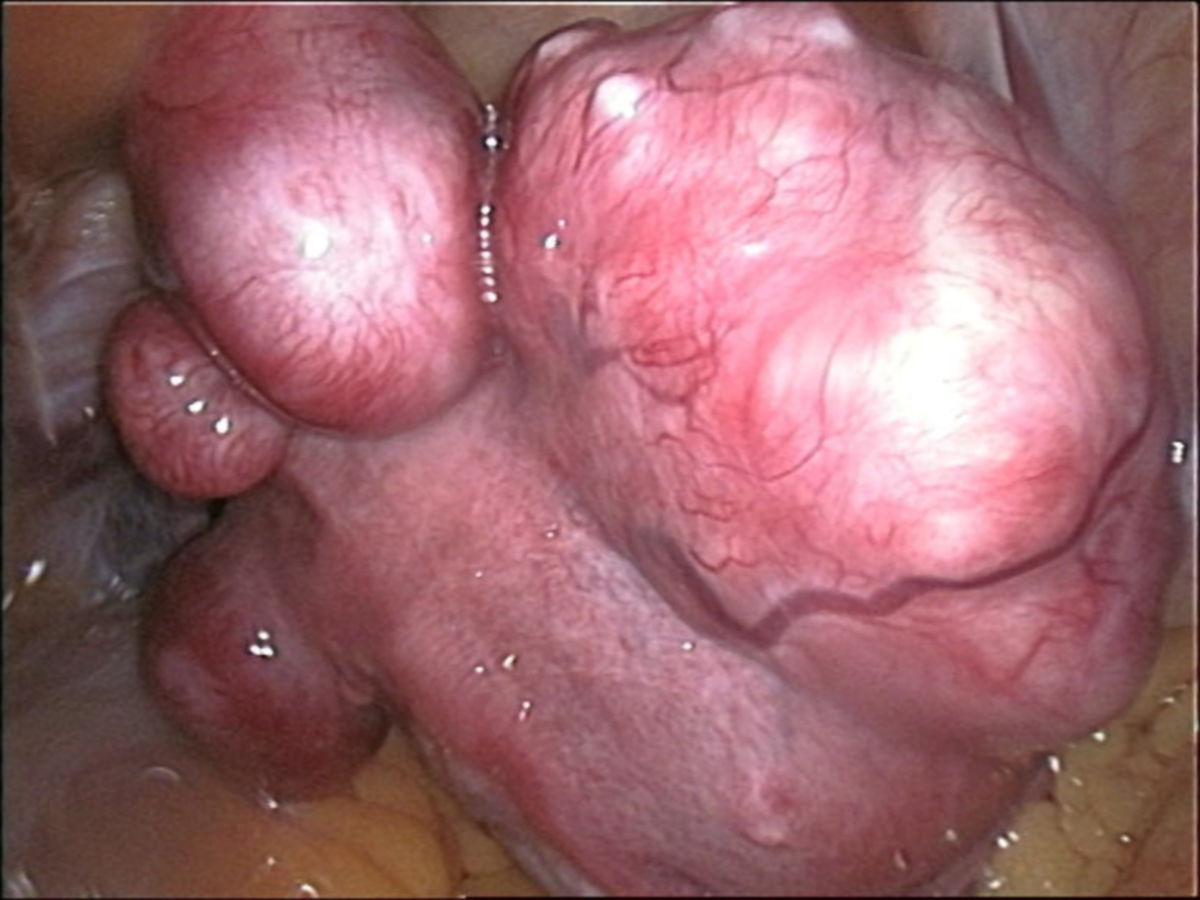 Mehrknolliger Uterus myomatosus