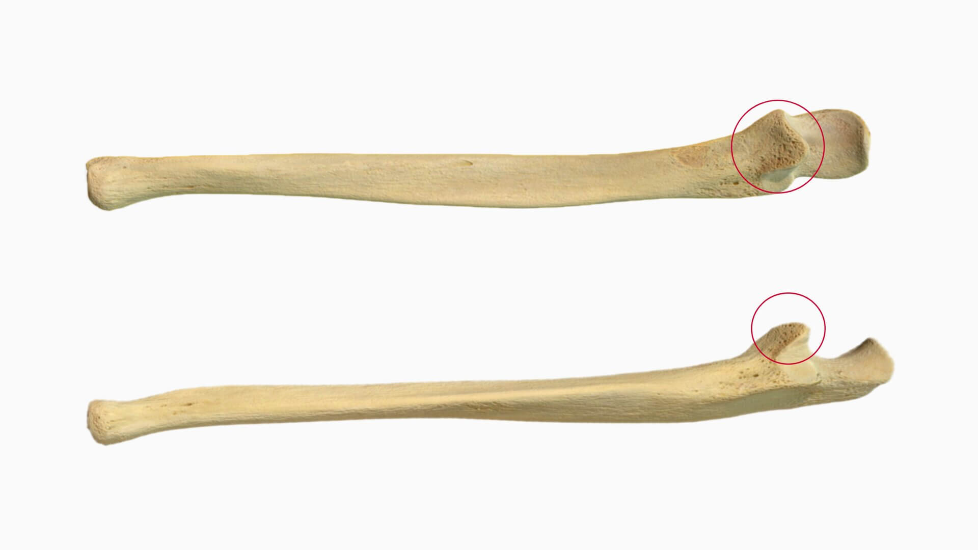 Processus coronoideus ulnae