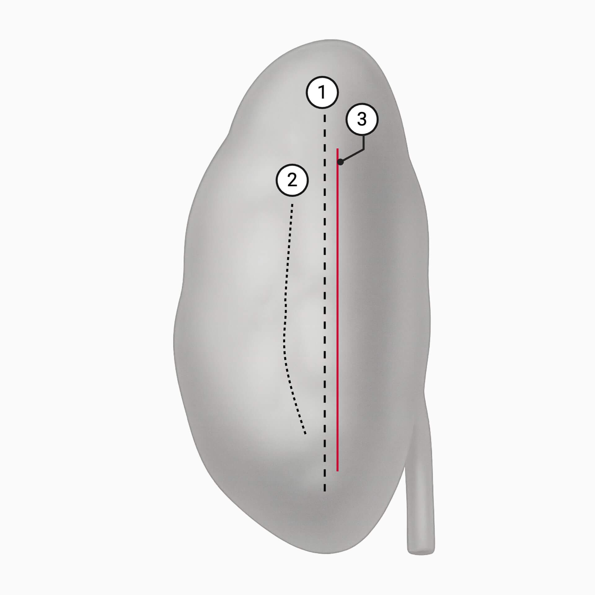 Laterale Ansicht der linken Niere mit Verlauf der Brödel-Linie