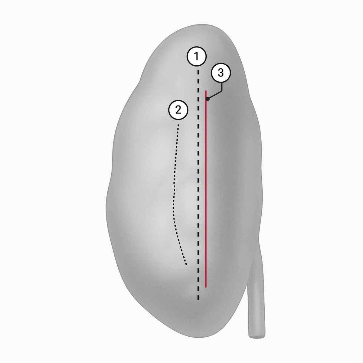 Laterale Ansicht der linken Niere mit Verlauf der Brödel-Linie