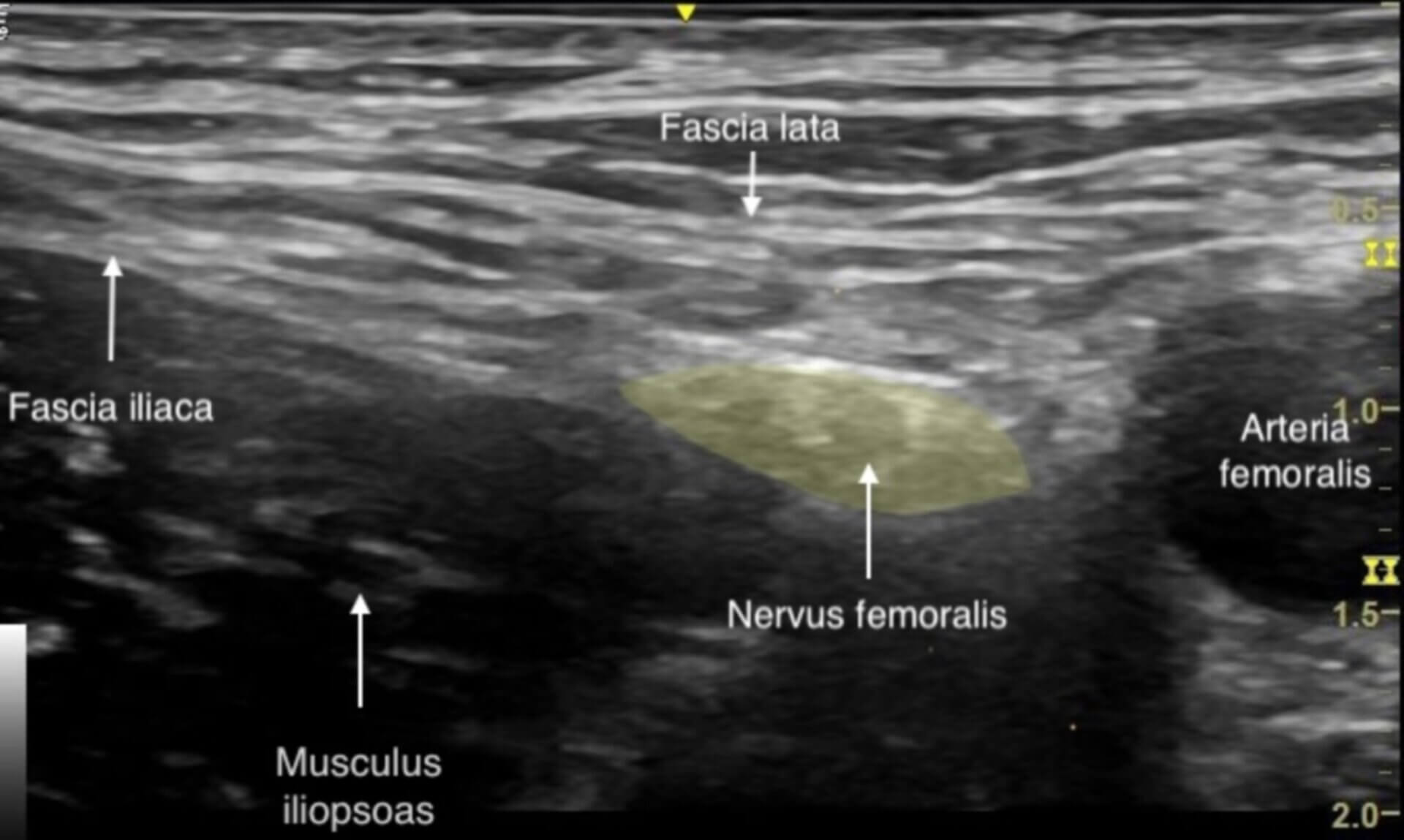 Sonographische Darstellung des Nervus femoralis