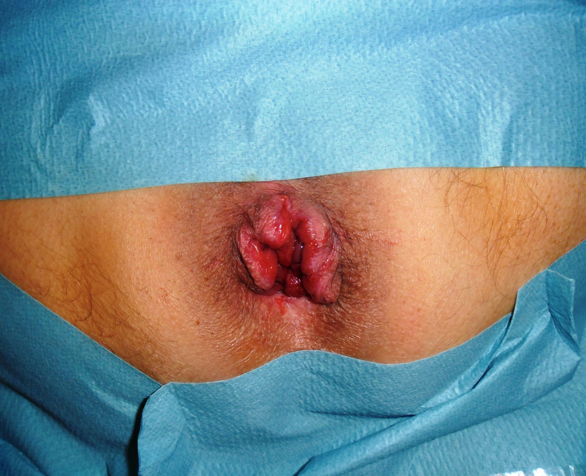 Hemorroides de 3er grado - prolapso anal