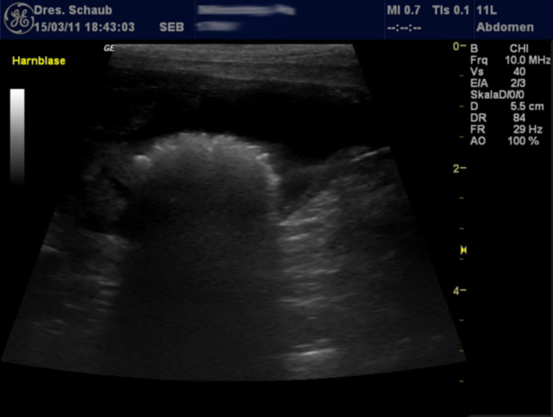 Sonography of urinary stone