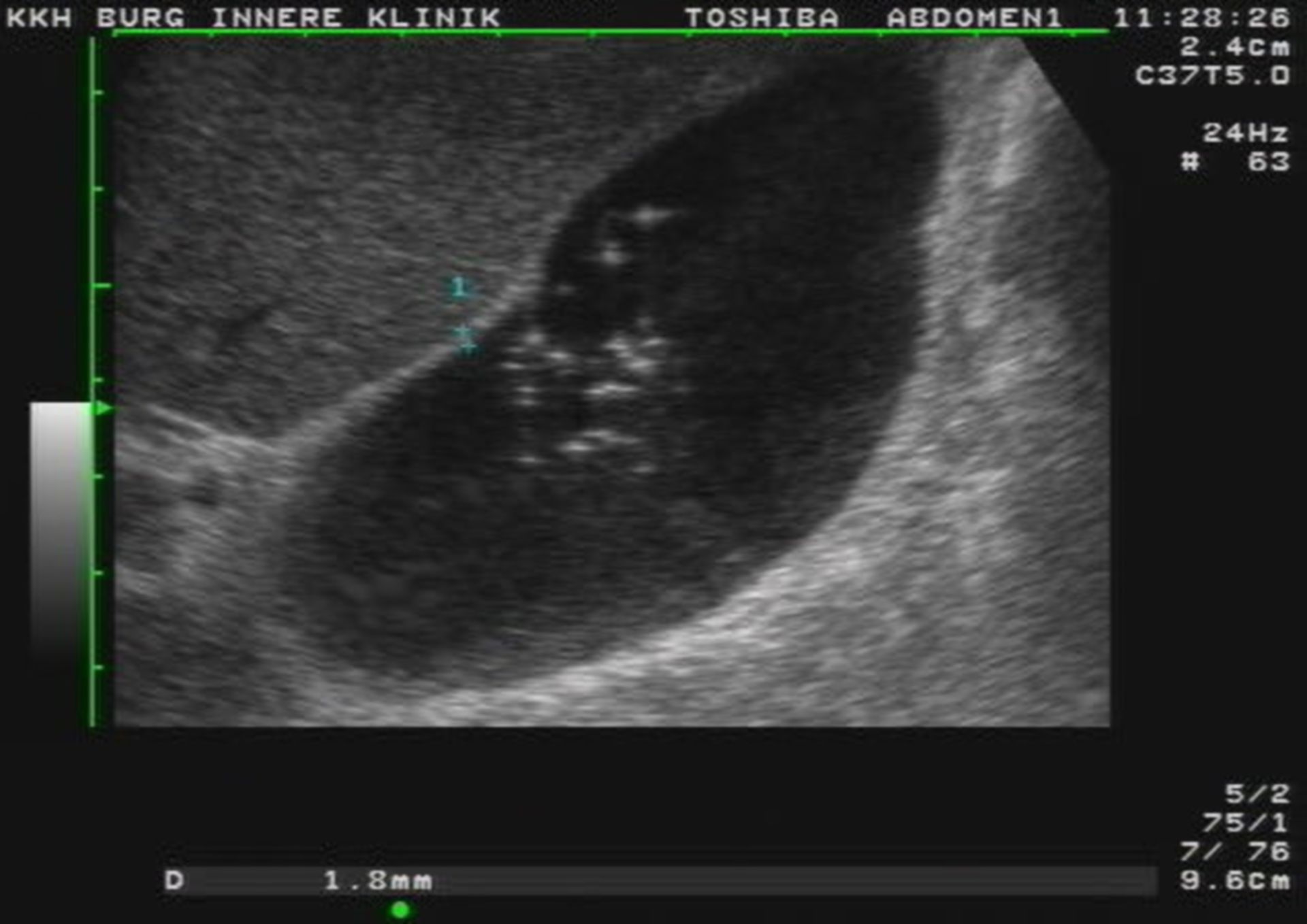 Empyema of the gallbladder