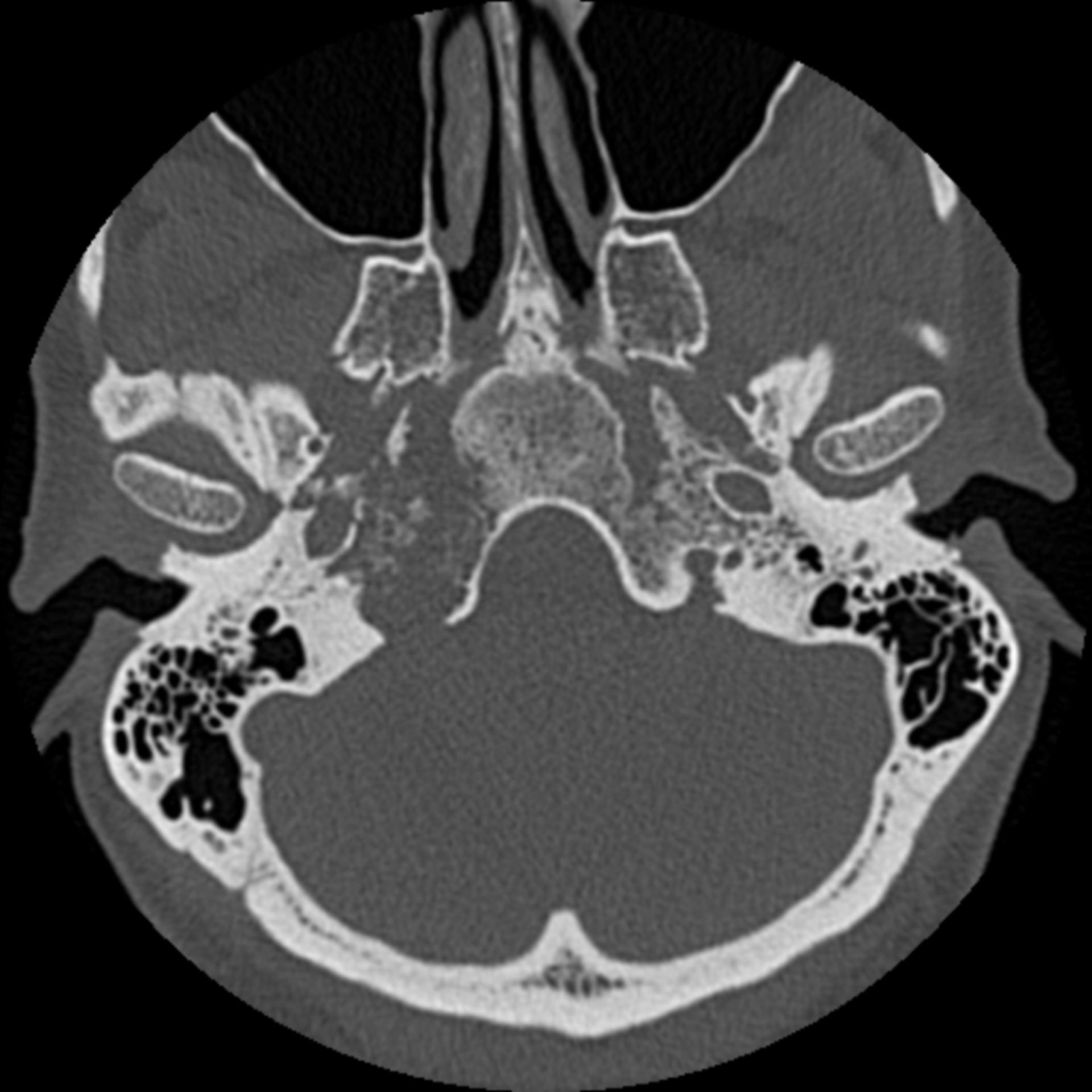 ct_tra200001: CT des Kopfes in transversaler Ebene