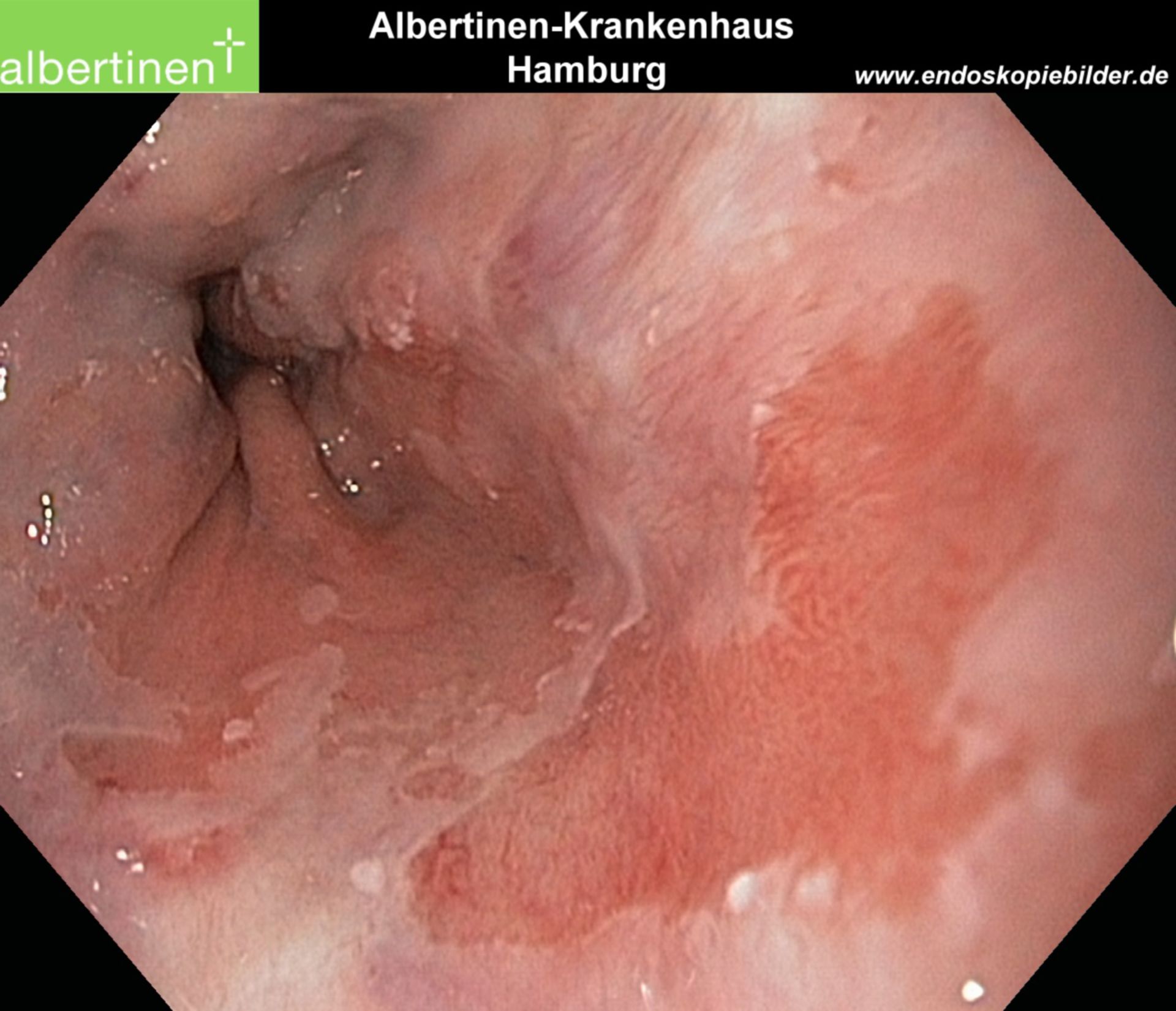 Endoscopia: metaplasia dell'esofago