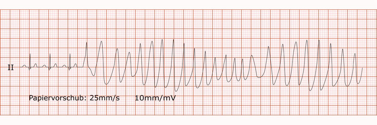 Rhythmusstreifen bei Sinusrhythmus gefolgt von Torsade-de-Pointes-Tachykardie