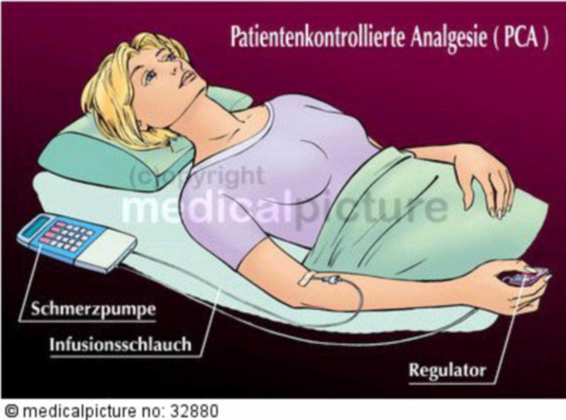  Patientenkontrollierte Analgesie (PCA) 
