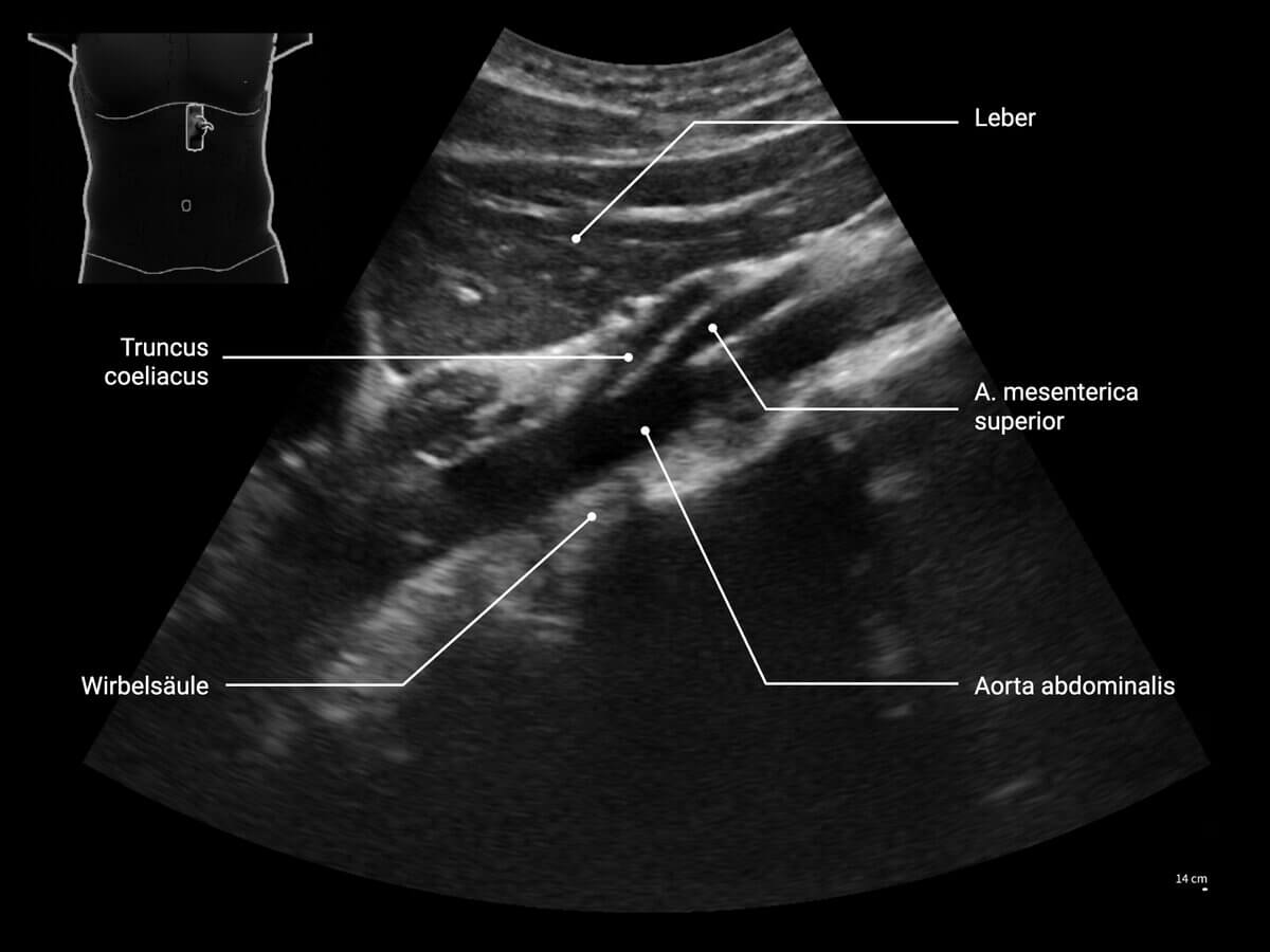 Aorta abdominalis