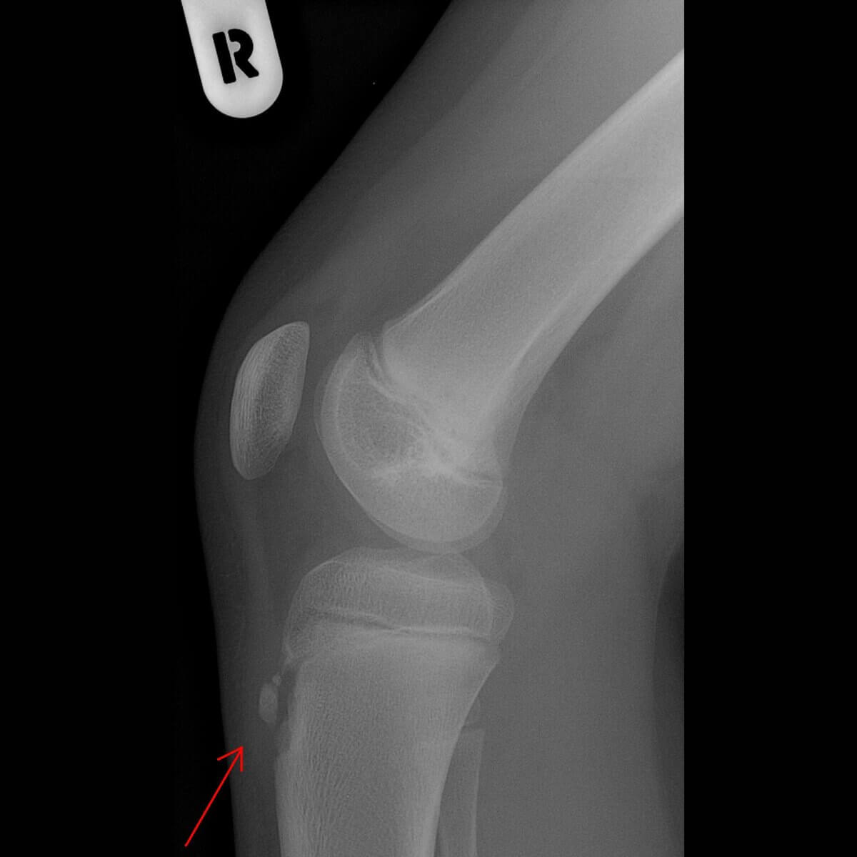 Morbus Osgood-Schlatter