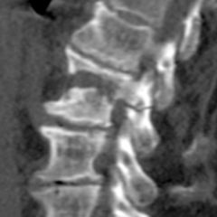 Wirbelkörperfraktur - DocCheck Flexikon